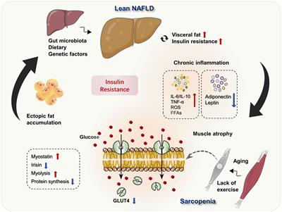 Lean nonalcoholic fatty liver disease and sarcopenia